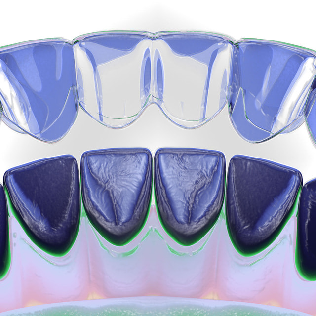 6 вещей, которые вам нужно знать про элайнеры для выравнивания зубов