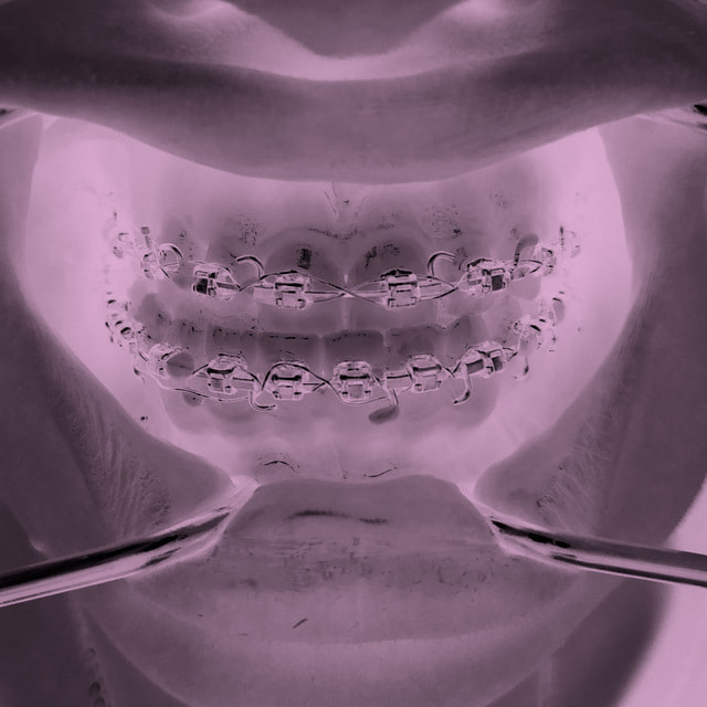 Отпилить челюсть, чтобы улыбаться. Как ортогнатическая операция меняет жизнь
